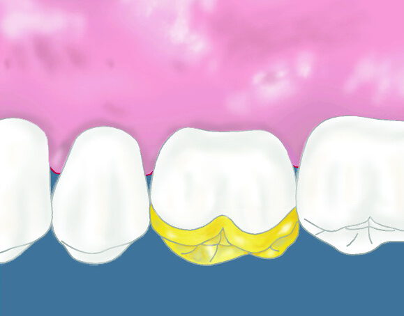 Illustration einer Zahn Teilkrone