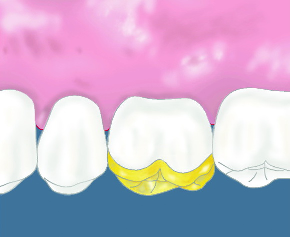 Illustration einer Zahn Teilkrone