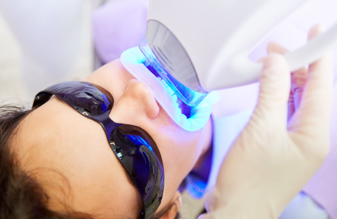 Behandlungsbild Zahn Bleaching